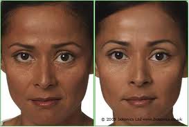 nasoloabial smile line fillers botox long island great neck